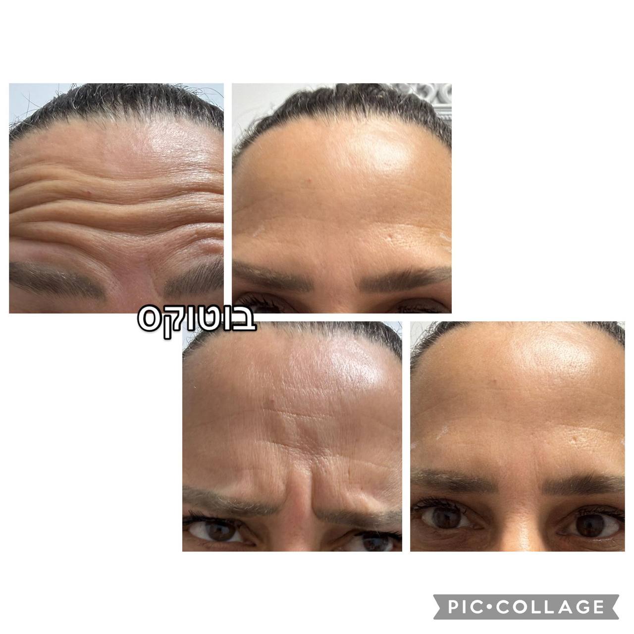 בוטוקס לפני ואחרי